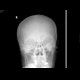 Fissure of the skull, mandible: X-ray - Plain radiograph